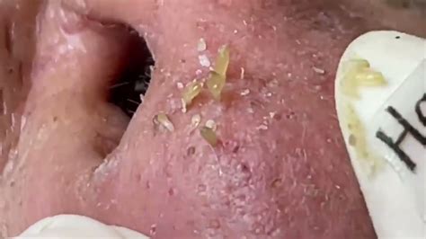 youtube blackhead removal